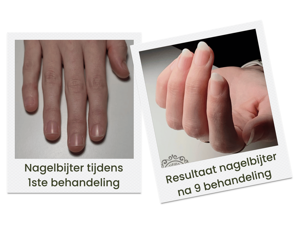 Nagelbijter-IBX-herstelprogramma-voor-na
