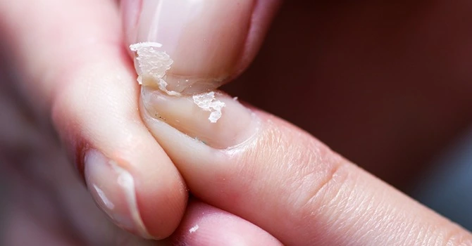 Nagelstudio Raalte Sterkegezondenagels inscheurde nagel foto